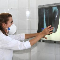 Bolsa Família pode ter reduzido em mais de 20% o índice de tuberculose