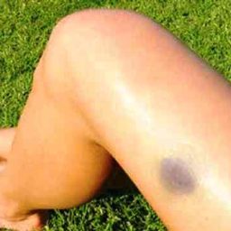 Hematoma que surge espontaneamente pode ser sinal de doenças