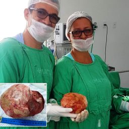 Lavrador de 51 anos tem pedra de 1,3 Kg e 18 cm retirada da bexiga em cirurgia na Bahia