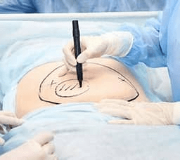 Abdominoplastia Combinada com Outras Cirurgias Estéticas: O Que Você Deve Saber