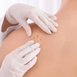 Médico lista sinais simples para saber se uma pinta é câncer de pele