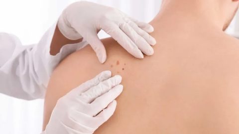 Médico lista sinais simples para saber se uma pinta é câncer de pele