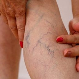 Mutirão gratuito para tratamento de varizes oferece 130 vagas em Salvador